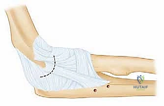 صورة توضيحية لـ إعادة بناء الرباط الجانبي الوحشي للمرفق مع الأستاذ الدكتور محمد هطيف