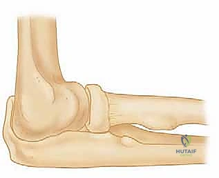 صورة توضيحية لـ إعادة بناء الرباط الجانبي الوحشي للمرفق مع الأستاذ الدكتور محمد هطيف