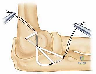 صورة توضيحية لـ إعادة بناء الرباط الجانبي الوحشي للمرفق مع الأستاذ الدكتور محمد هطيف