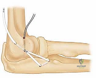 إعادة بناء الرباط الجانبي الوحشي للمرفق مع الأستاذ الدكتور محمد هطيف