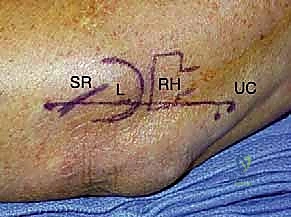 توضيح لعدم استقرار الكوع