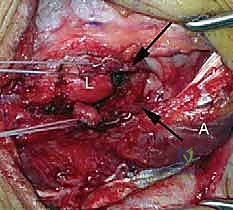 صورة طبية: إعادة بناء الرباط الجانبي الوحشي للمرفق مع الأستاذ الدكتور محمد هطيف