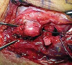 صورة طبية: إعادة بناء الرباط الجانبي الوحشي للمرفق مع الأستاذ الدكتور محمد هطيف