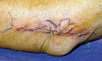 صورة طبية: إعادة بناء الرباط الجانبي الوحشي للمرفق مع الأستاذ الدكتور محمد هطيف