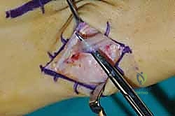 تحديد مواقع الشقوق الجراحية