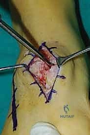 تشريح منتصف القدم وعظام الرسغ