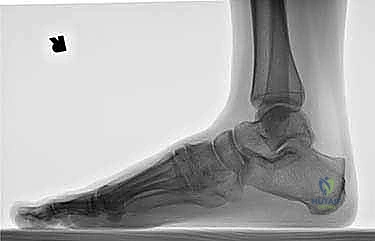 تثبيت مفصل منتصف القدم: حل دائم لتشوهات القدم المعقدة واستعادة الحركة