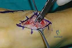 تجهيز المريض للعملية الجراحية