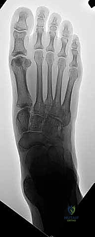 Midfoot Arthrodesis: An Intraoperative Masterclass for Complex Deformity