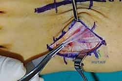 تقييم زوايا العظام