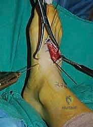 استخدام الميكروسكوب الجراحي للرؤية الدقيقة