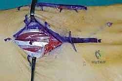 التحضير لفتح الجلد