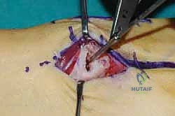 صورة طبية: تثبيت مفصل منتصف القدم: حل دائم لتشوهات القدم المعقدة واستعادة الحركة