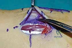 بداية الإجراء الجراحي