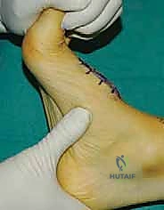 فحص أسطح المفاصل