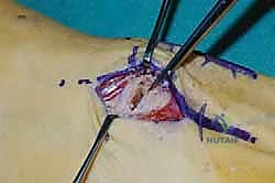 كشف العظام والمفاصل التالفة