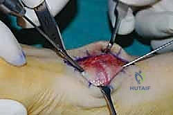 كحت الغضروف بالكامل