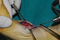 إبعاد الأنسجة الرخوة بعناية