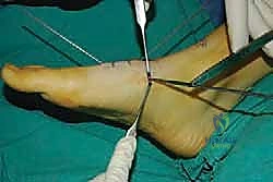 صورة طبية: تثبيت مفصل منتصف القدم: حل دائم لتشوهات القدم المعقدة واستعادة الحركة