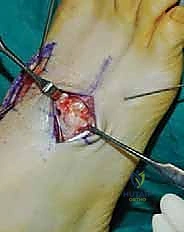 تجهيز السطح العظمي للالتحام