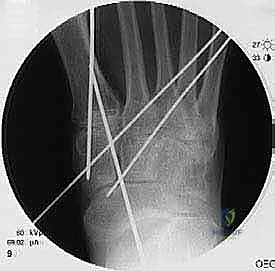 فحص سريري لحالة منتصف القدم