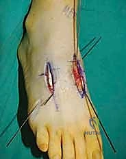 صورة شعاعية توضح التلف المفصلي