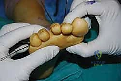 تنظيف المفصل من الشوائب العظمية