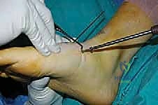 صورة طبية: تثبيت مفصل منتصف القدم: حل دائم لتشوهات القدم المعقدة واستعادة الحركة