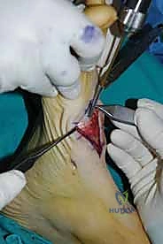 صورة طبية: تثبيت مفصل منتصف القدم: حل دائم لتشوهات القدم المعقدة واستعادة الحركة