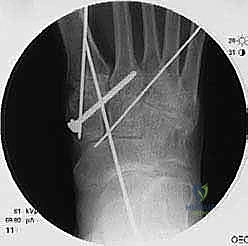 استخدام مفك براغي خاص لضمان الإحكام