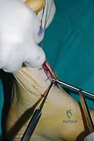 صورة طبية: تثبيت مفصل منتصف القدم: حل دائم لتشوهات القدم المعقدة واستعادة الحركة