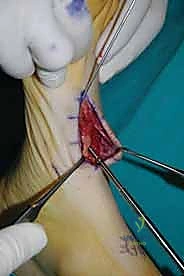 صورة طبية: تثبيت مفصل منتصف القدم: حل دائم لتشوهات القدم المعقدة واستعادة الحركة