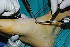 صورة طبية: تثبيت مفصل منتصف القدم: حل دائم لتشوهات القدم المعقدة واستعادة الحركة