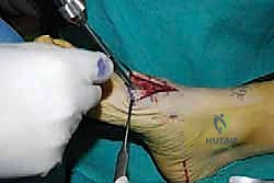 صورة طبية: تثبيت مفصل منتصف القدم: حل دائم لتشوهات القدم المعقدة واستعادة الحركة