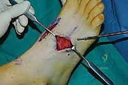 صورة طبية: تثبيت مفصل منتصف القدم: حل دائم لتشوهات القدم المعقدة واستعادة الحركة