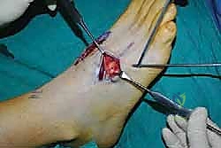 صورة توضيحية لـ تثبيت مفصل منتصف القدم: حل دائم لتشوهات القدم المعقدة واستعادة الحركة