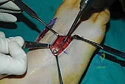 صورة طبية: تثبيت مفصل منتصف القدم: حل دائم لتشوهات القدم المعقدة واستعادة الحركة