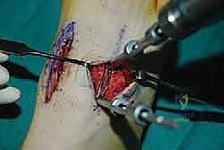 صورة طبية: تثبيت مفصل منتصف القدم: حل دائم لتشوهات القدم المعقدة واستعادة الحركة