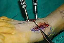 صورة طبية: تثبيت مفصل منتصف القدم: حل دائم لتشوهات القدم المعقدة واستعادة الحركة