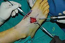 صورة طبية: تثبيت مفصل منتصف القدم: حل دائم لتشوهات القدم المعقدة واستعادة الحركة