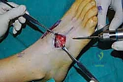 صورة طبية: تثبيت مفصل منتصف القدم: حل دائم لتشوهات القدم المعقدة واستعادة الحركة