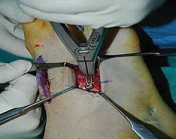 صورة طبية: تثبيت مفصل منتصف القدم: حل دائم لتشوهات القدم المعقدة واستعادة الحركة