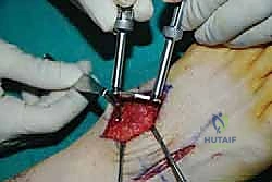 وضع الشريحة على العظام المجهزة