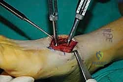 صورة طبية: تثبيت مفصل منتصف القدم: حل دائم لتشوهات القدم المعقدة واستعادة الحركة