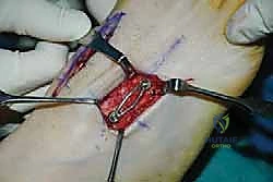 إدخال المسمار المجوف فوق السلك الدليلي