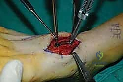 صورة طبية: تثبيت مفصل منتصف القدم: حل دائم لتشوهات القدم المعقدة واستعادة الحركة