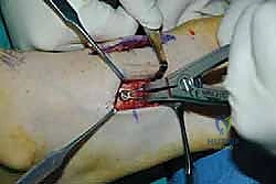 صورة طبية: تثبيت مفصل منتصف القدم: حل دائم لتشوهات القدم المعقدة واستعادة الحركة