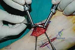 صورة طبية: تثبيت مفصل منتصف القدم: حل دائم لتشوهات القدم المعقدة واستعادة الحركة