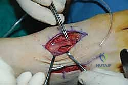 صورة طبية: تثبيت مفصل منتصف القدم: حل دائم لتشوهات القدم المعقدة واستعادة الحركة