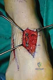 صورة طبية: تثبيت مفصل منتصف القدم: حل دائم لتشوهات القدم المعقدة واستعادة الحركة